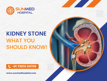 Kidney-Stone-What-you-should-know